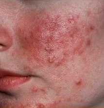 Clínica de Rosácea